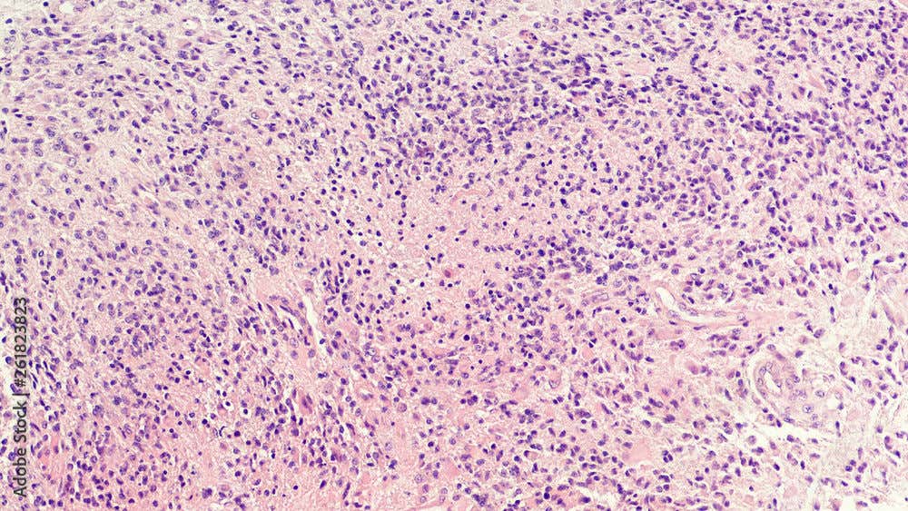 oncology